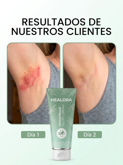 Crema Healora® Anti-Roce